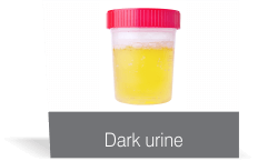 Dark Urine