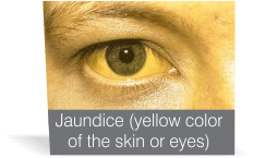 Jaundice